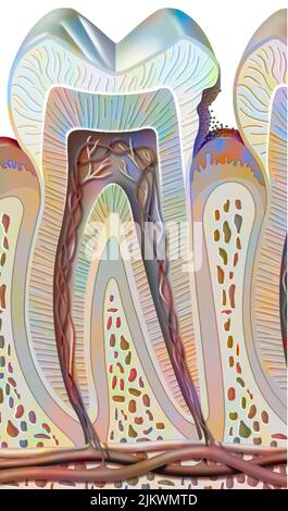 Zahnkaries im ersten Stadium (Zahnschmelzschäden). Stockfoto