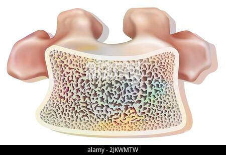 Aufbau eines gesunden dorsalen Wirbels mit schwammigem und kompaktem Gewebe. Stockfoto