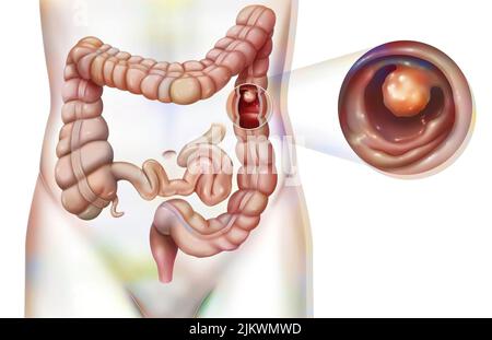 Verdauungssystem: Der Dickdarm mit einem kolonischen Polyp. Stockfoto