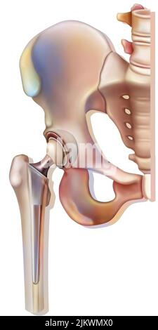 Knochensystem: Hüftprothese. Stockfoto