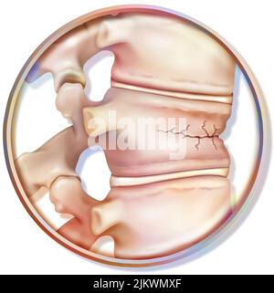 Wirbelkompression durch Bruch der durch Osteoporose geschwächten Wirbel. Stockfoto