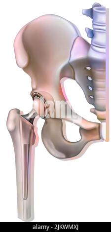 Knochensystem: Hüftprothese. Stockfoto