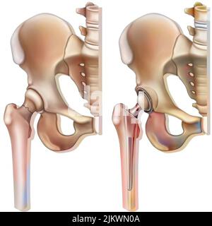 Oberschenkelhalsfraktur (Osteoporose) und Hüftprothese. Stockfoto