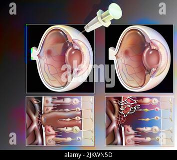 Auge: Behandlung der Makuladegeneration durch RNA-Interferenz. Stockfoto