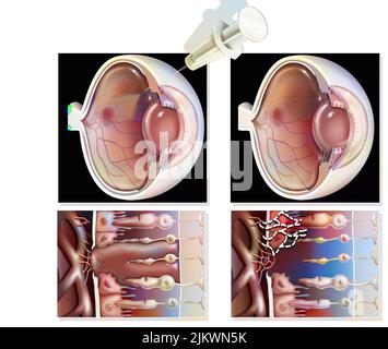 Auge: Behandlung der Makuladegeneration durch RNA-Interferenz. Stockfoto