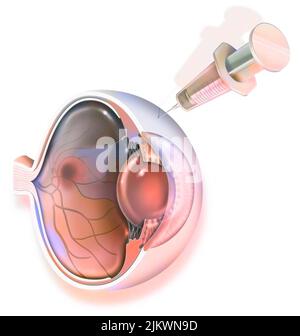 Auge: Behandlung der Makuladegeneration durch RNA-Interferenz. Stockfoto