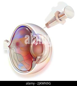 Auge: Behandlung der Makuladegeneration durch RNA-Interferenz. Stockfoto