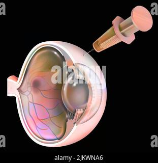 Auge: Behandlung der Makuladegeneration durch RNA-Interferenz. Stockfoto