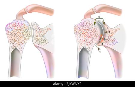 Gesunder Knöchel mit hämophiler Arthropathie im Frontalschnitt. Stockfoto