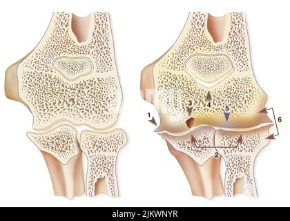 Vergleich zwischen einem gesunden Ellenbogen und einer hämophilen Arthropathie (Hämarthrose). Stockfoto