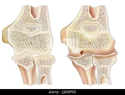 Vergleich zwischen einem gesunden Ellenbogen und einer hämophilen Arthropathie (Hämarthrose). Stockfoto