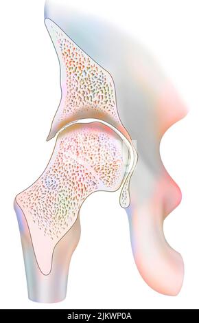 Knöchel durch hämophile Arthropathie im frontalen Schnitt betroffen. Stockfoto