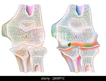 Vergleich zwischen einem gesunden Ellenbogen und einer hämophilen Arthropathie (Hämarthrose). Stockfoto