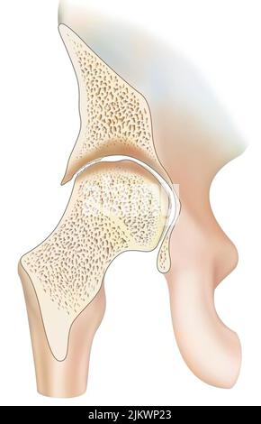 Knöchel durch hämophile Arthropathie im frontalen Schnitt betroffen. Stockfoto
