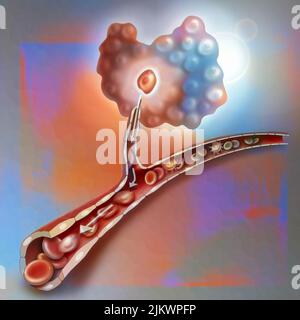 Ausbreitung von Metastasen im Körper, wobei der Tumor die Angiogenese auslöst. Stockfoto