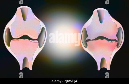 Anatomie des Gelenks eines gesunden Knies links, eines durch Arthrose deformiert rechts. Stockfoto