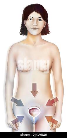 Gesunde oder betroffene Blase (Blasenentzündung, Krebs, Lithiasis..) Bei Frauen. Stockfoto