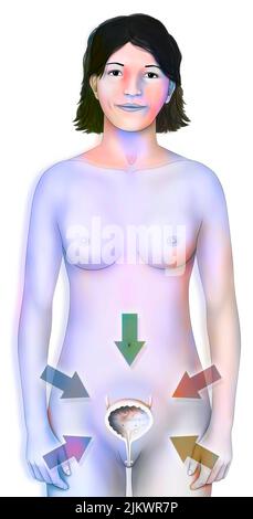 Gesunde oder betroffene Blase (Blasenentzündung, Krebs, Lithiasis..) Bei Frauen. Stockfoto