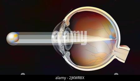 Astigmatisches Auge (eiförmige und nicht-kugelförmige Hornhaut) mit der Bildung eines Bildes. Stockfoto