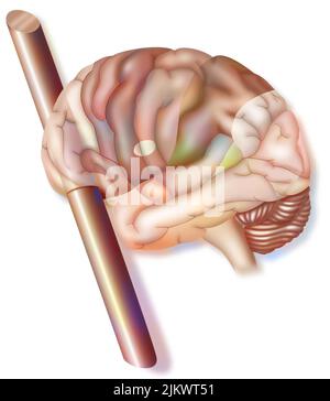 Der Frontallappen: Einfluss des Stabes im Schädel von Phineas Gage auf seine Emotionen. Stockfoto