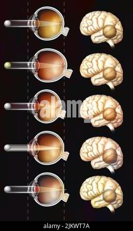 Auge: Vergleich zwischen einem normalen Auge und einem myopischen, hyperopischen, astigmatischen, presbyopischen Auge. Stockfoto