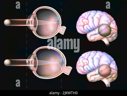 Vergleich zwischen normalem Sehen und dem eines myopischen Auges. Stockfoto