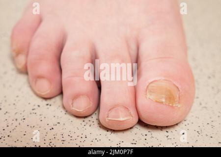 Zehennägel mit Pilzinfektion und Prellungen an Großzehenmakros Stockfoto