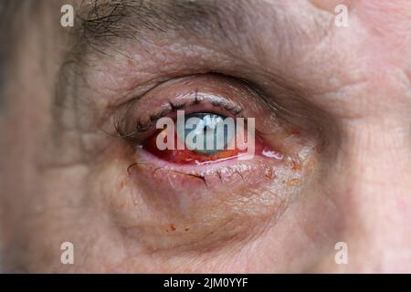 Auge eines Mannes mit einer durch einen Unfall verletzten Konjunktiva, mit mehreren Stichen genäht und Blutabnahme nach der Operation, Gesundheit und medizinische Thema, auswählen Stockfoto