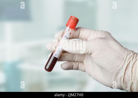Nahaufnahme einer Hand in medizinischen Handschuhen, die eine Blutsonde handhaben Stockfoto