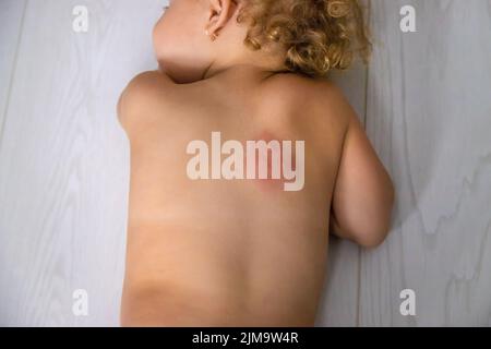 Mückenstiche auf dem Rücken eines Kindes. Selektiver Fokus. Kind. Stockfoto