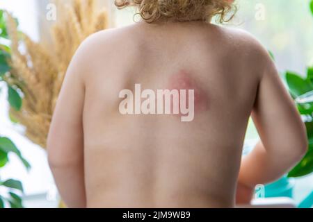 Mückenstiche auf dem Rücken eines Kindes. Selektiver Fokus. Kind. Stockfoto