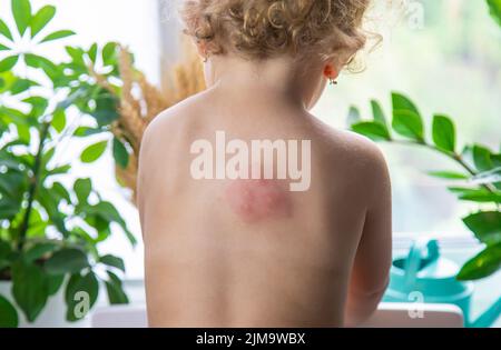 Mückenstiche auf dem Rücken eines Kindes. Selektiver Fokus. Kind. Stockfoto