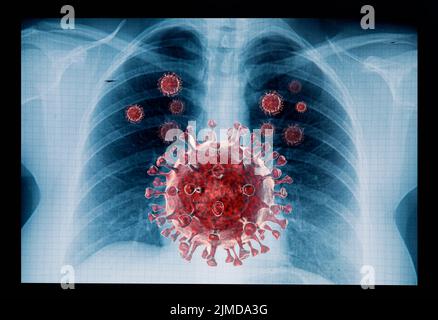 Coronavirus-Krankheit COVID-19-Virusinfektion in der menschlichen Lunge Stockfoto