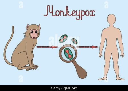 Monkeypox. Diagramm der menschlichen Infektion mit dem Pockenvirus. Affe - Virus - Mensch. Darstellung von Farbvektoren. Zoonotische Viruserkrankung. Stock Vektor