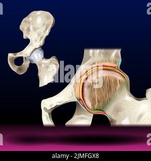 Septische Arthritis Hüfte - Kniegelenk mit Arthritis ( Gicht , rheumatoide Arthritis , septische Arthritis , Arthrose Knie ) Stockfoto