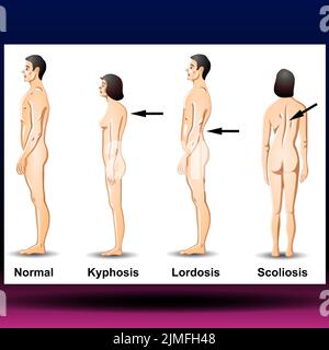 Wirbelsäulenkurven - Wirbelsäulendeformität. Symbol für Wirbelsäulenverkrümmungen oder ungesunde Rückenknochen. Anatomie der menschlichen Wirbelsäule, gekrümmte Wirbelsäule. Stockfoto