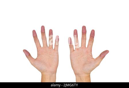 Zyanotische Hände oder periphere Zyanose oder blaue Hände bei einem jungen Mann aus Südostasien Stockfoto