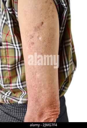 Altersflecken und weiße Flecken am Arm des älteren asiatischen Mannes. Diese Altersflecken sind braune, graue oder schwarze Flecken und werden auch als Leberflecken, senile Lentigo, so bezeichnet Stockfoto