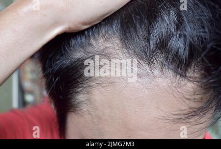 Dünner werdendes oder spärliches Haar, Haarausfall nach männlichem Muster in südostasiatischem, chinesischem jungen Mann. Stockfoto