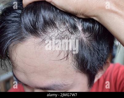 Dünner werdendes oder spärliches Haar, Haarausfall nach männlichem Muster in südostasiatischem, chinesischem jungen Mann. Stockfoto