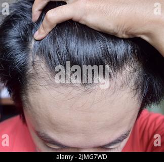 Dünner werdendes oder spärliches Haar, Haarausfall nach männlichem Muster in südostasiatischem, chinesischem jungen Mann. Stockfoto