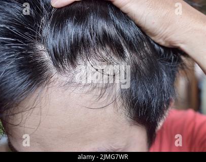 Dünner werdendes oder spärliches Haar, Haarausfall nach männlichem Muster in südostasiatischem, chinesischem jungen Mann. Stockfoto