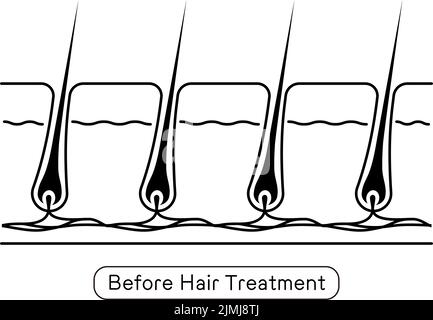 Bild der Haarentfernung, vor und unbehandeltes Haar Stock Vektor