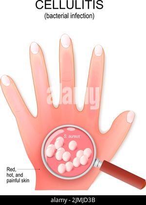 Zellulitis. Die Handfläche des Menschen mit einer bakteriellen Infektion. Nahaufnahme der Bakterienkolonie. Lupe und Staphylococcus aureus. vektorgrafik Stock Vektor