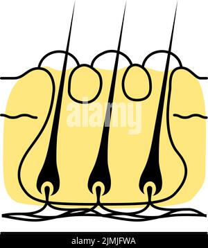 Illustration eines „Karbunkels“, einer subkutanen Verbindung mehrerer Furunkel, die durch Follikulitis verstärkt werden. Stock Vektor