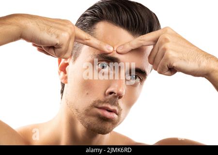 Der junge Mann quetscht den Pickel auf seine Stirn Stockfoto