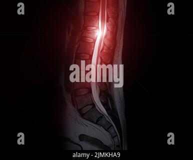 MRT Lendenwirbelsäule sagittal T2W Fettunterdrückung. Stockfoto