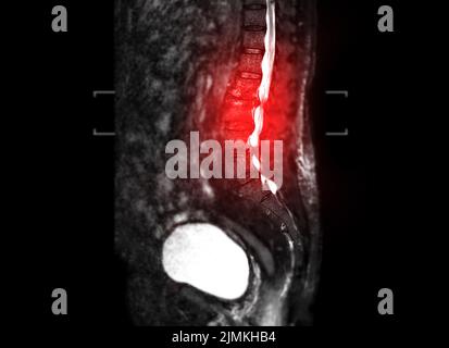 MRT Lendenwirbelsäule sagittal T2W Fettunterdrückung. Stockfoto