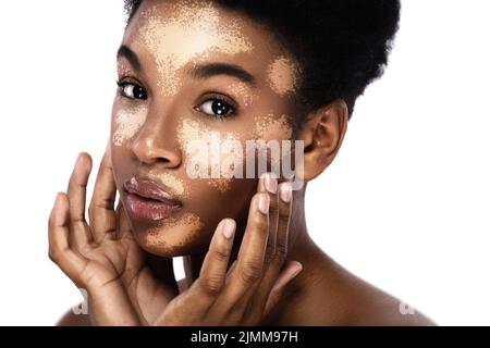 Schöne schwarze Frau mit Vitiligo Hautstörung Stockfoto