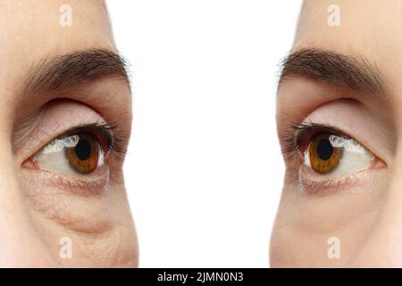 Anti-Aging-Behandlung. Weibliche Augen nach der Verjüngung. Stockfoto
